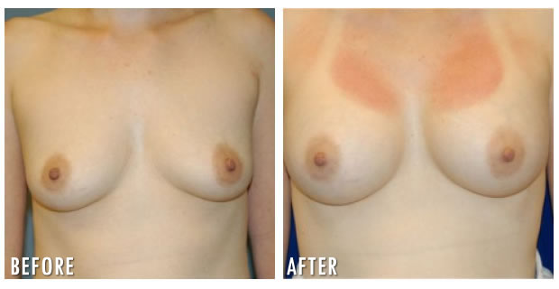 Breast Augmentation Before And After 1