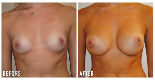 Breast Augmentation Before And After 10