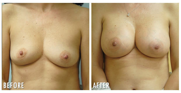 Breast Augmentation Before And After 11