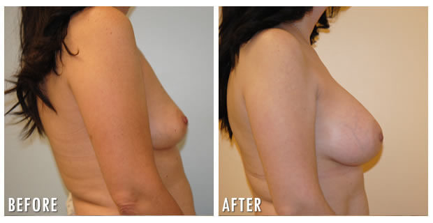 Breast Augmentation Before And After 12