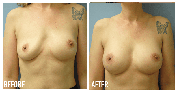 Breast Augmentation Before And After 14