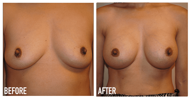 Breast Augmentation Before And After 15