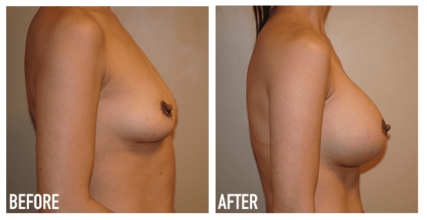 Breast Augmentation Before And After 16