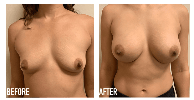 Breast Augmentation Before And After 17