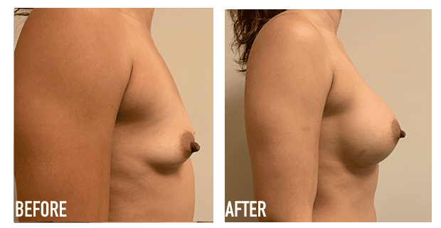 Breast Augmentation Before And After 18