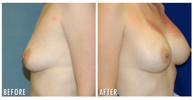 Breast Augmentation Before And After 2