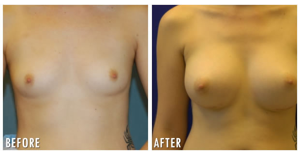 Breast Augmentation Before And After 3