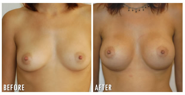 Breast Augmentation Before And After 5