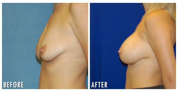 Breast Augmentation Before And After 8