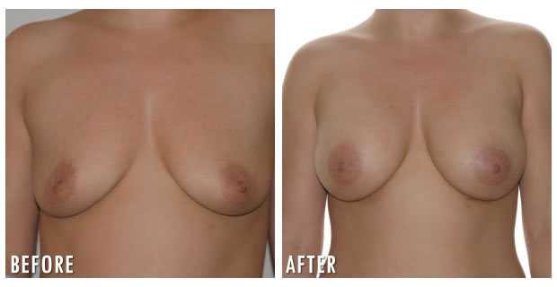 Breast Augmentation Before And After 9