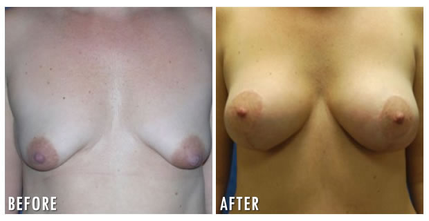 Breast Lift Before And After 3