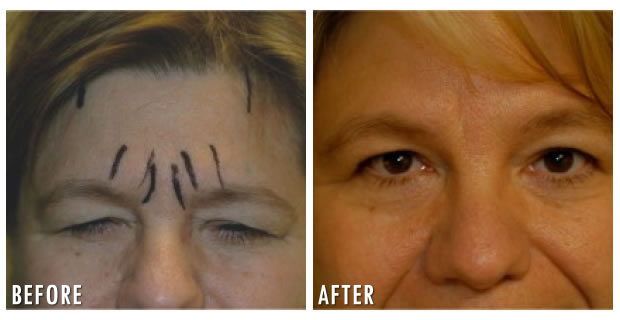 Brow Lift Before And After 1