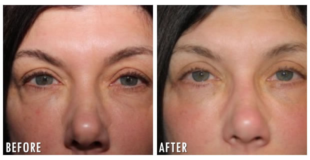 Eyelid Lift Before And After 1