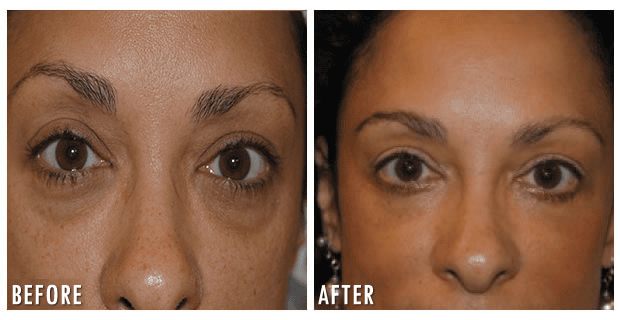 Eyelid Lift Before And After 2