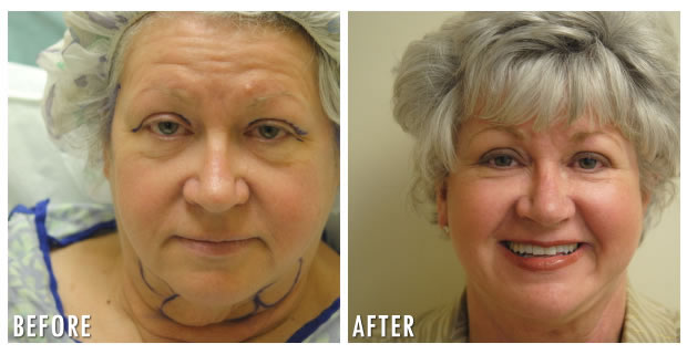 Facelift Before And After 1