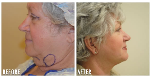 Facelift Before And After 2