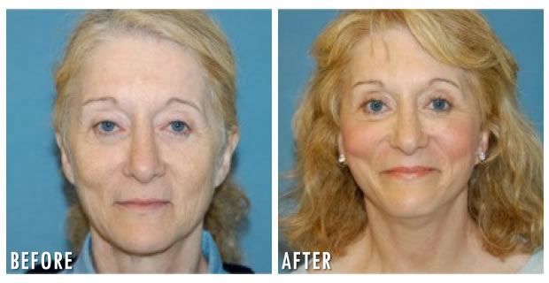 Facelift Before And After 3