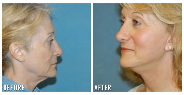 Facelift Before And After 4