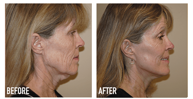 Facelift Before And After 5