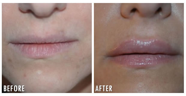 Lip Augmentation Before And After 1