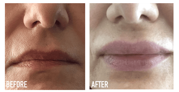 Lip Augmentation Before And After 2