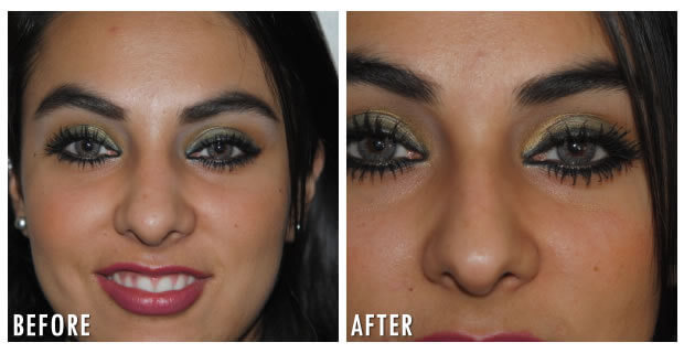 Nose Reshaping Before And After 1