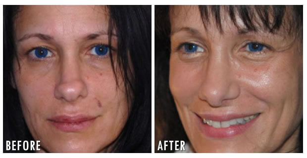 Nose Reshaping Before And After 10