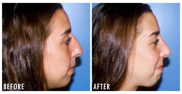 Nose Reshaping Before And After 11