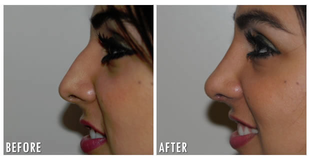 Nose Reshaping Before And After 2