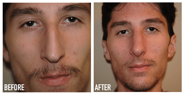 Nose Reshaping Before And After 3