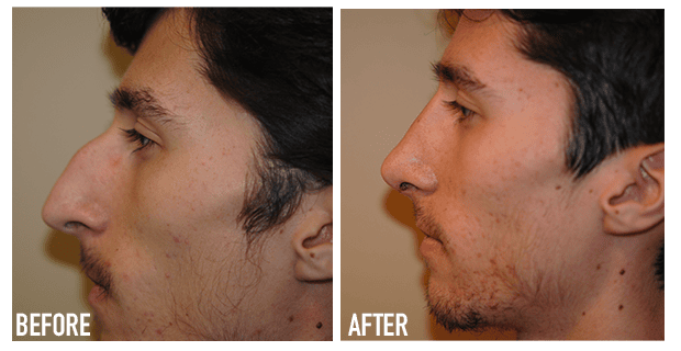 Nose Reshaping Before And After 4