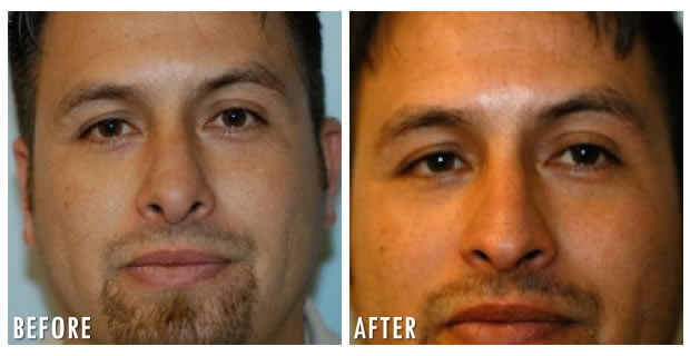 Nose Reshaping Before And After 5