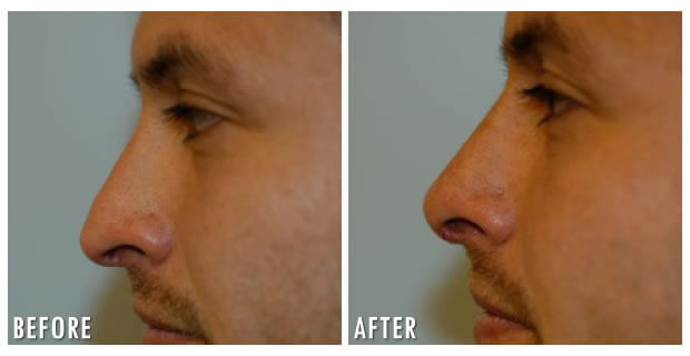 Nose Reshaping Before And After 6