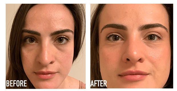 Nose Reshaping Before And After 7