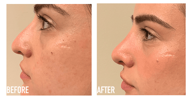 Nose Reshaping Before And After 8