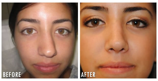 Nose Reshaping Before And After 9