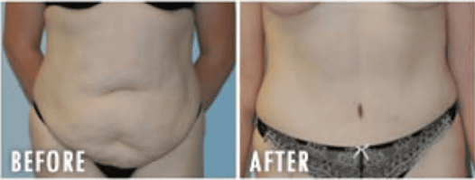 Tummy Tuck Before And After