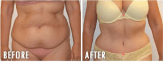 Tummy Tuck Before And After