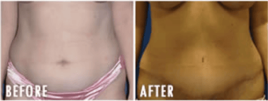 Tummy Tuck Before And After