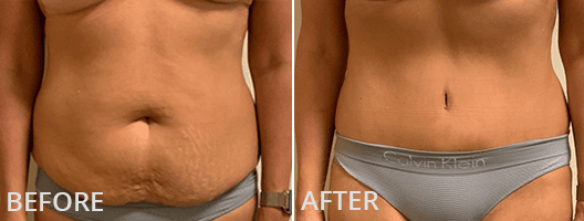 Tummy Tuck Before And After 4