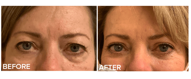 Upper And Lower Lid Lift Blepharoplasty Before And After