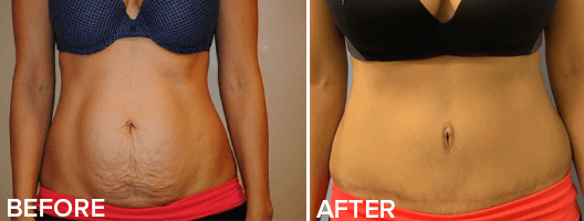 Tummy Tuck Before And After