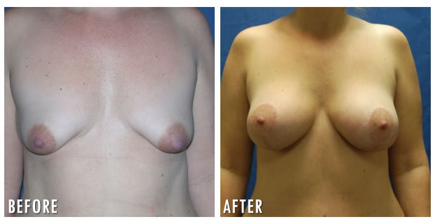 Breast Augmentation With Lift Before And After