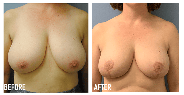 Breast Reduction Before And After 1