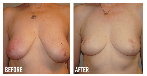 Breast Reduction Before And After 2