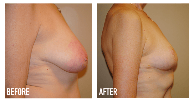 Breast Reduction Before And After 3