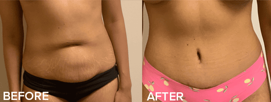 Tummy Tuck Before And After