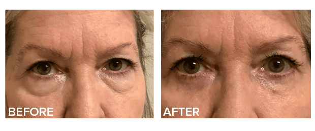 Lower Lid Blepharoplasty Before And After