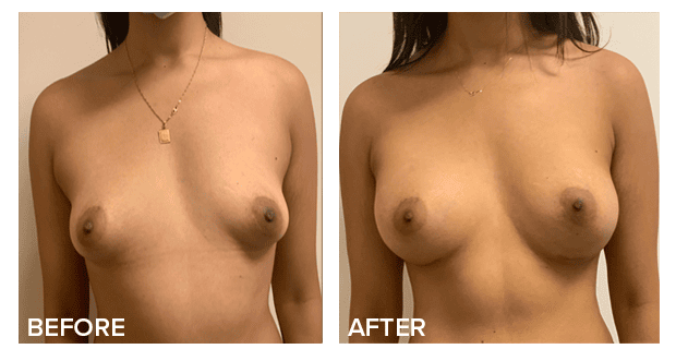 Breast Augmentation With Lift Before And After