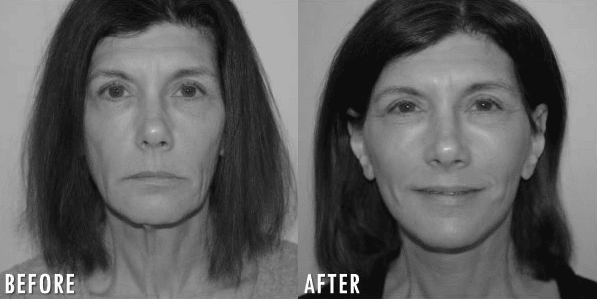 Canoun Custom Facelift Patient Before And After Grayscale